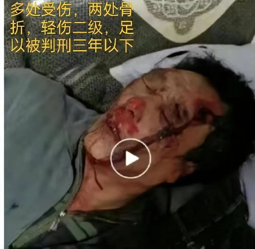 图片[7] - 无法无天？67岁老人讨薪被毒打两次，打人者仅拘留七天，保释后拿刀上门恐吓 - 万事屋 | 生活·动漫·娱乐综合社区-银魂同好聚集地