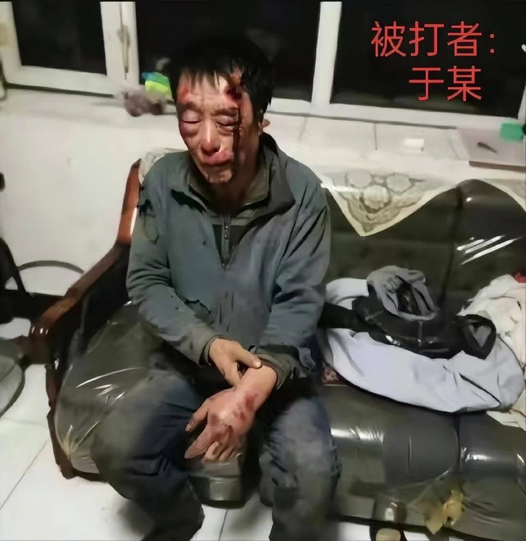 图片[2] - 无法无天？67岁老人讨薪被毒打两次，打人者仅拘留七天，保释后拿刀上门恐吓 - 万事屋 | 生活·动漫·娱乐综合社区-银魂同好聚集地