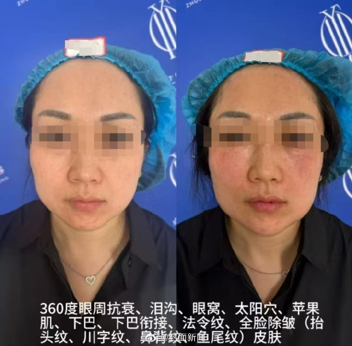 女子贷款4万花10万做医美崩溃：家人说不如2000元打肉毒素 - 万事屋 | 生活·动漫·娱乐综合社区-银魂同好聚集地