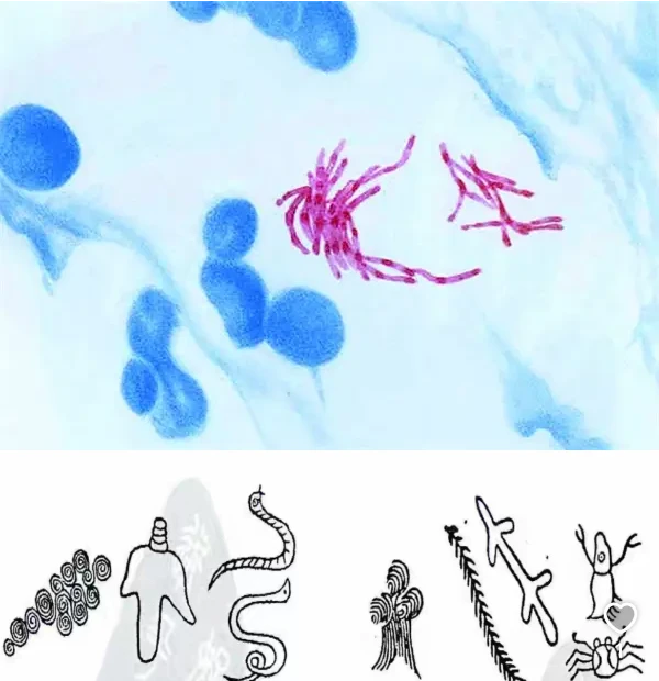 肺痨治疗:从“痨虫蚀肺”到结核杆菌的科学进化