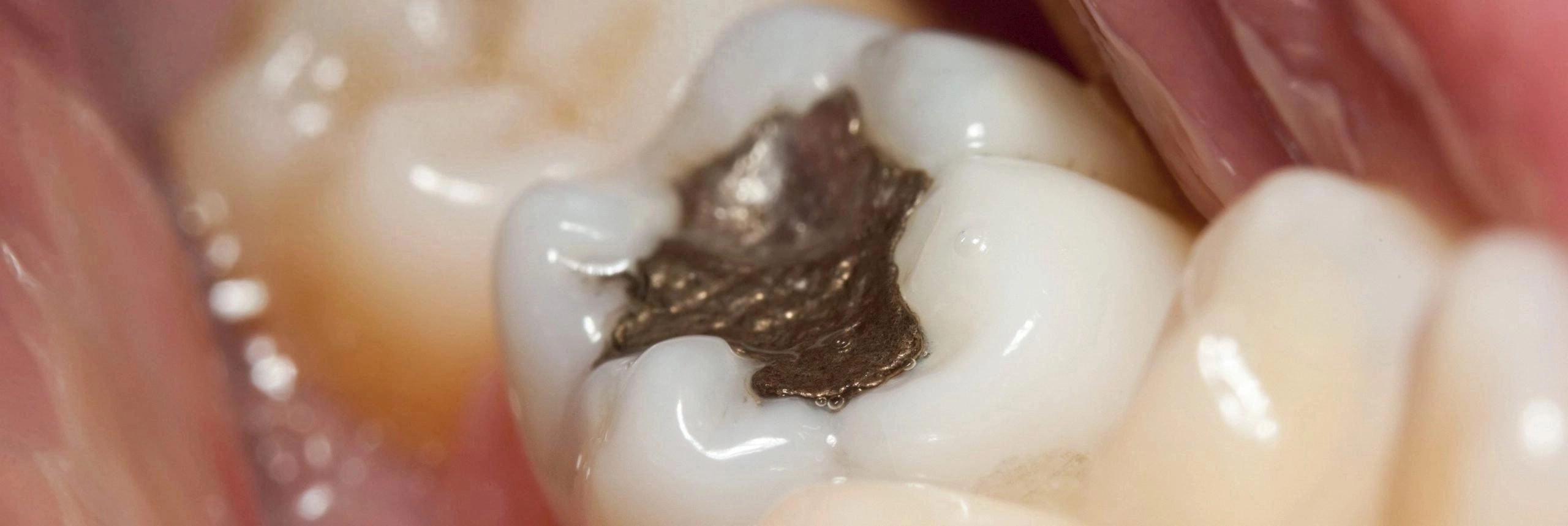 鱼类体内毒素含量引发呼吁 环境组织要求全英禁止使用汞基牙科填充材料 - 万事屋 | 生活·动漫·娱乐综合社区-银魂同好聚集地