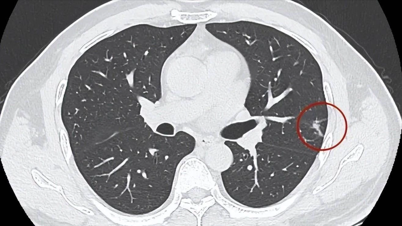 医生研究发现：人患肺癌前1年，身体一般会出现7个预警信号