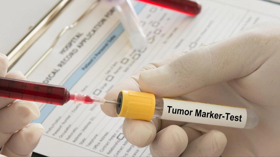 医生研究发现：人患肺癌前1年，身体一般会出现7个预警信号