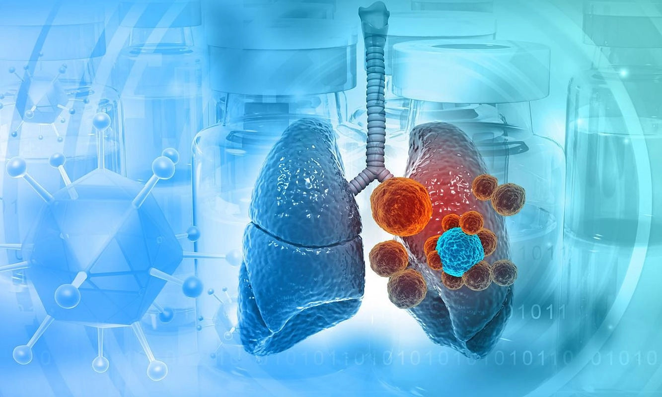 医生研究发现：人患肺癌前1年，身体一般会出现7个预警信号