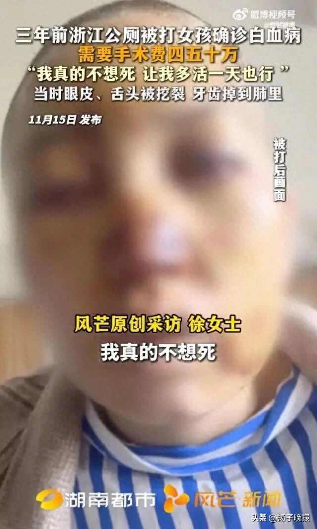 浙江公厕被陌生男子殴打20分钟的女孩确诊白血病:我真的不想死 - 万事屋 | 生活·动漫·娱乐综合社区-银魂同好聚集地