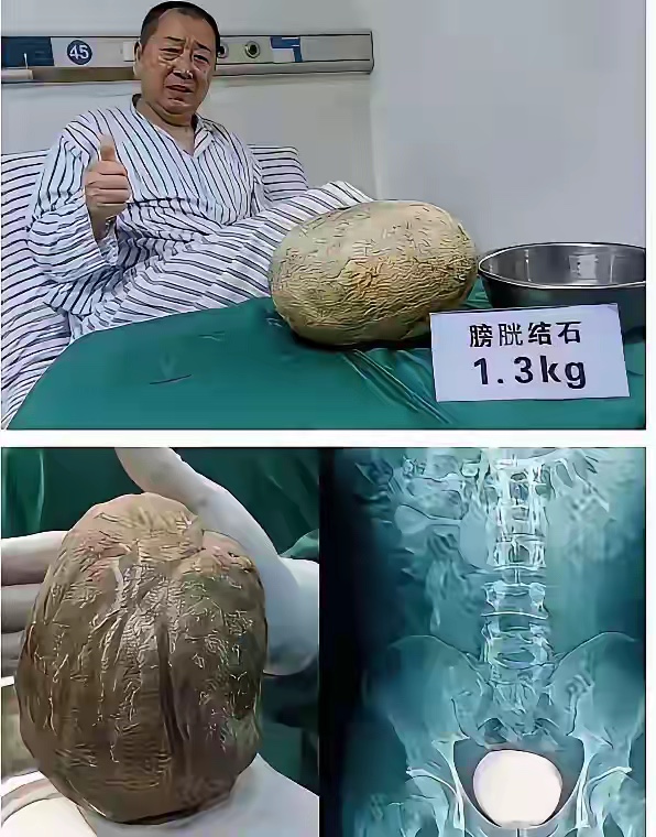 你们管这个东西叫结石？ - 万事屋